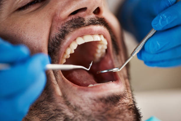 Tooth Infection Emergency Dentist in CA